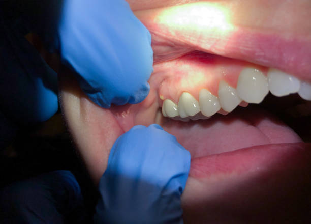 Best Emergency Wisdom Tooth Extraction in Bangor, MI